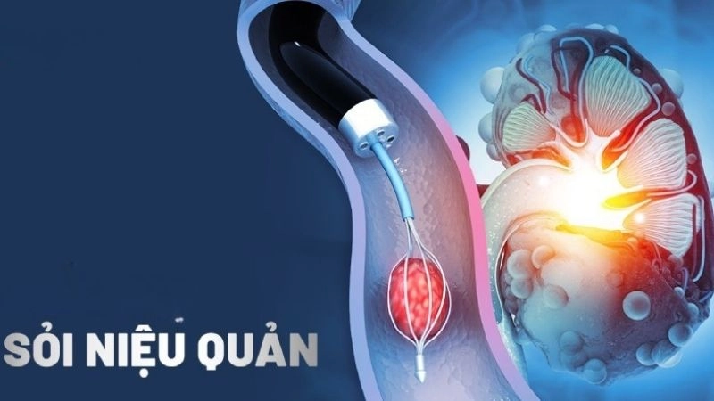 Niệu quản là đường dẫn nước tiểu giữa thận và bàng quang