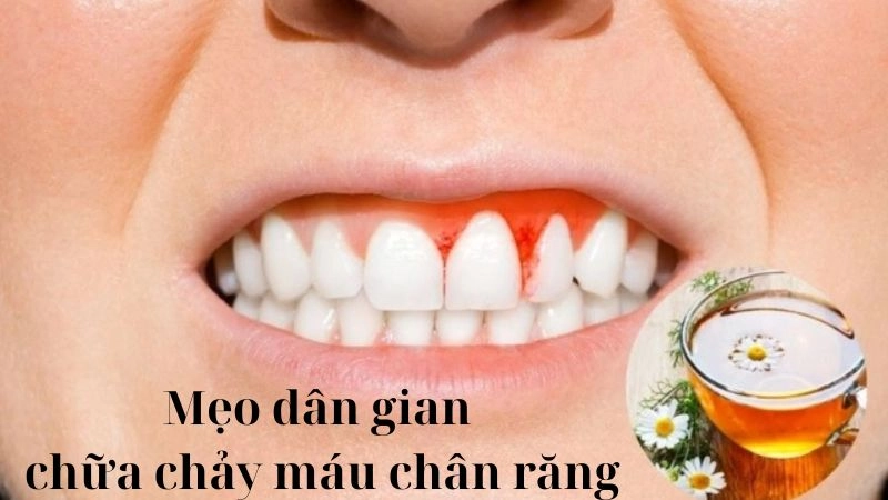 Chia sẻ mẹo dân gian chữa chảy máu chân răng đơn giản nhất