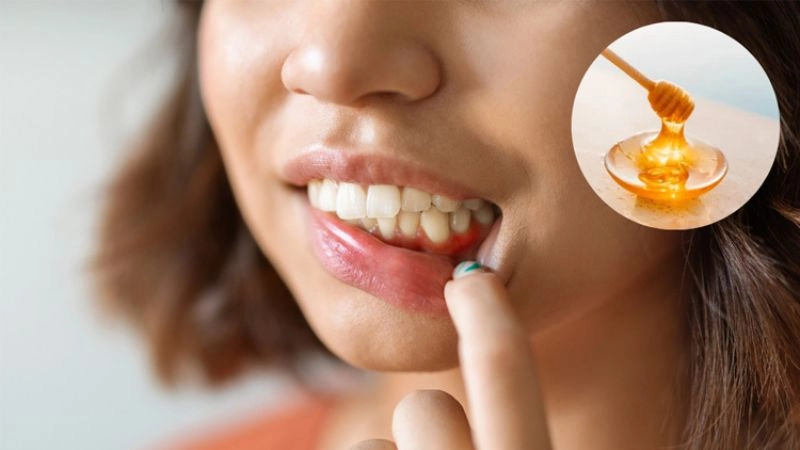 Mẹo dân gian chữa chảy máu chân răng tại nhà