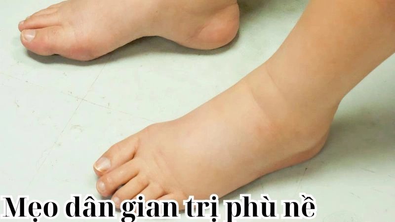 Bí quyết mẹo dân gian trị phù nề từ kinh nghiệm dân gian xưa