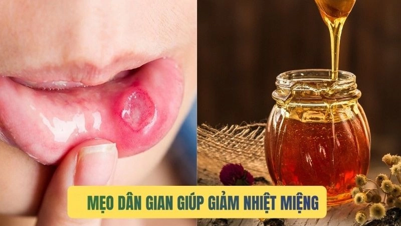 Bí quyết dân gian trị nhiệt miệng hiệu quả an toàn tự nhiên