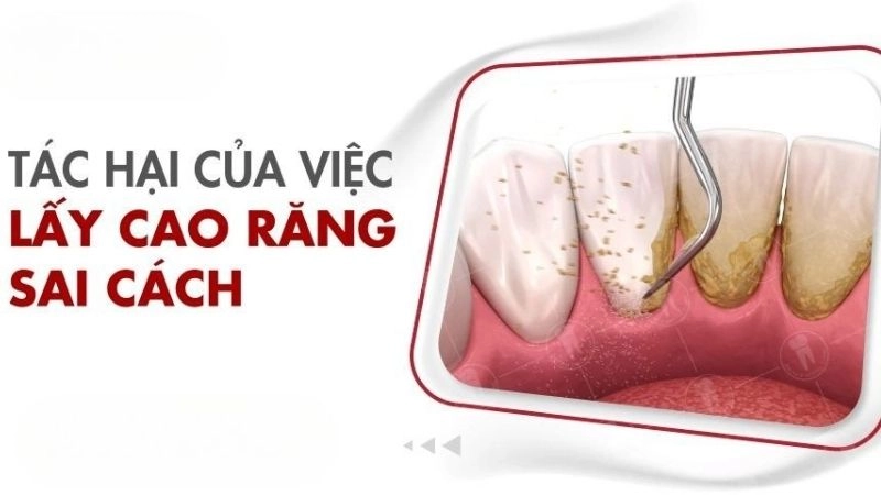 Tưởng vô hại nhưng lấy cao răng sai cách gây họa thế nào