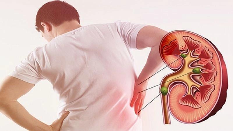 Tác hại ăn nhiều mì tôm khiến cơ thể dễ suy nhược