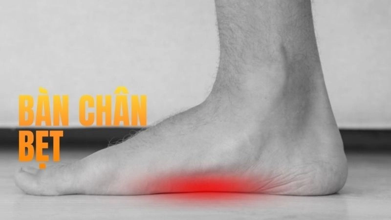 Chuyên gia cảnh báo tác hại bàn chân bẹt ít ai nghĩ tới