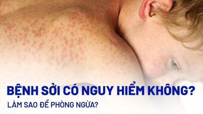 Cảnh báo tác hại bệnh sởi gây biến chứng nguy hiểm toàn cầu