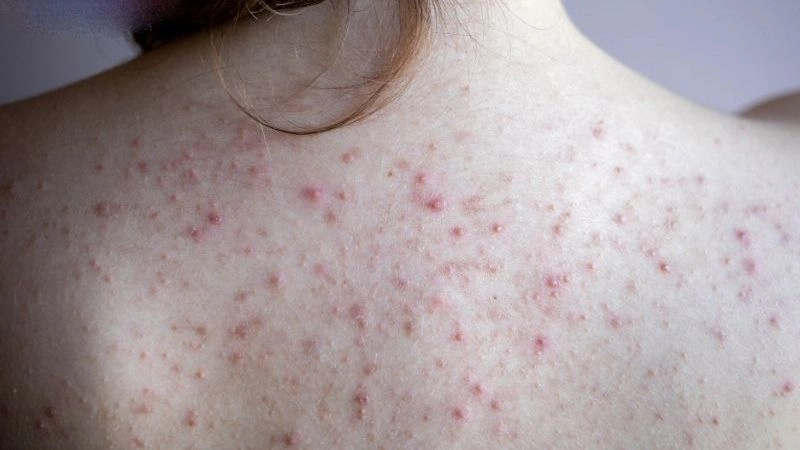 Kem trộn gây tổn thương sâu trên bề mặt da