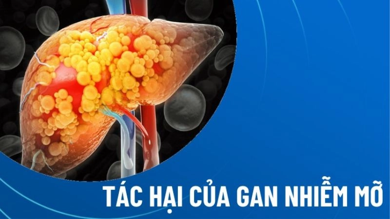 Hiểu rõ tác hại của gan nhiễm mỡ để bảo vệ sức khỏe tối ưu