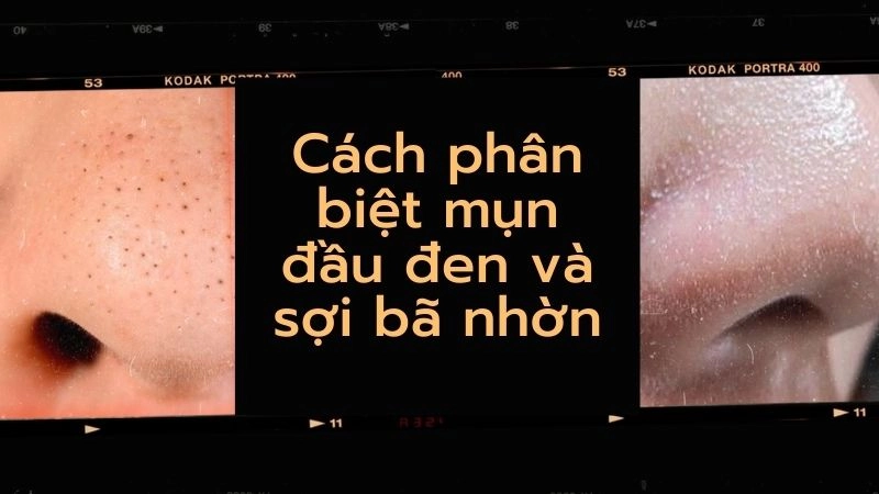 Cách phân biệt mụn đầu đen và sợi bã nhờn chính xác 100%