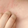 Bí quyết chữa mề đay bằng mẹo dân gian hiệu quả tại nhà