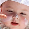 Mẹo Chữa Chàm Sữa Ở Trẻ Sơ Sinh Hiệu Quả Theo Dân Gian Và Khoa Học