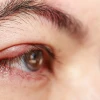 Mẹo Chữa Lẹo Mắt Cột Chỉ: Hiệu Quả Và Cách Thực Hiện Đơn Giản