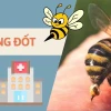 Mẹo Dân Gian Chữa Ong Đốt Hiệu Quả Ngay Tại Nhà