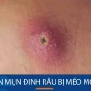 Nặn mụn đinh râu bị méo mồm: Nguyên nhân và cách xử lý an toàn
