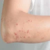 Nhiễm Giun Đũa Chó Mèo: Nguyên Nhân Gây Dị Ứng Da và Cách Xử Lý Hiệu Quả
