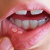Những tác hại tiềm ẩn của bột quế bạn cần biết