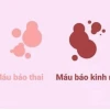 Phân biệt máu báo thai và máu kinh nguyệt: Dấu hiệu nhận biết và thời điểm