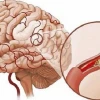 Phân biệt Nhồi máu não và Xuất huyết não: Nhận biết sớm, Cứu sống kịp thời