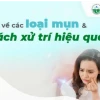 Phân biệt rõ 9 loại mụn thường gặp và cách điều trị hiệu quả