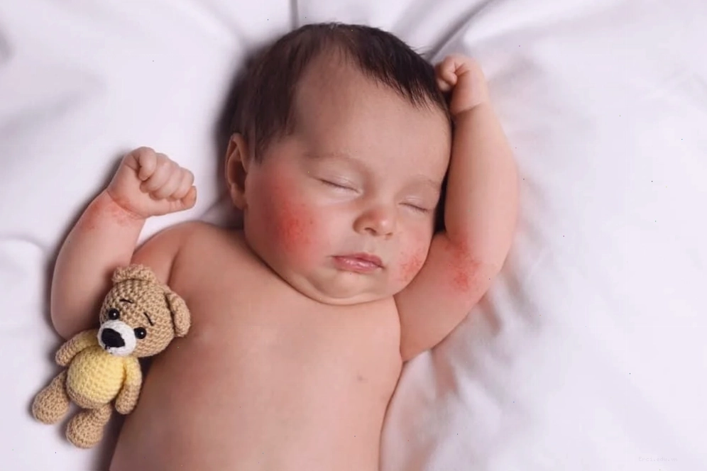 Bé sơ sinh bị chàm sữa trên má với các mảng đỏ khô ráp
