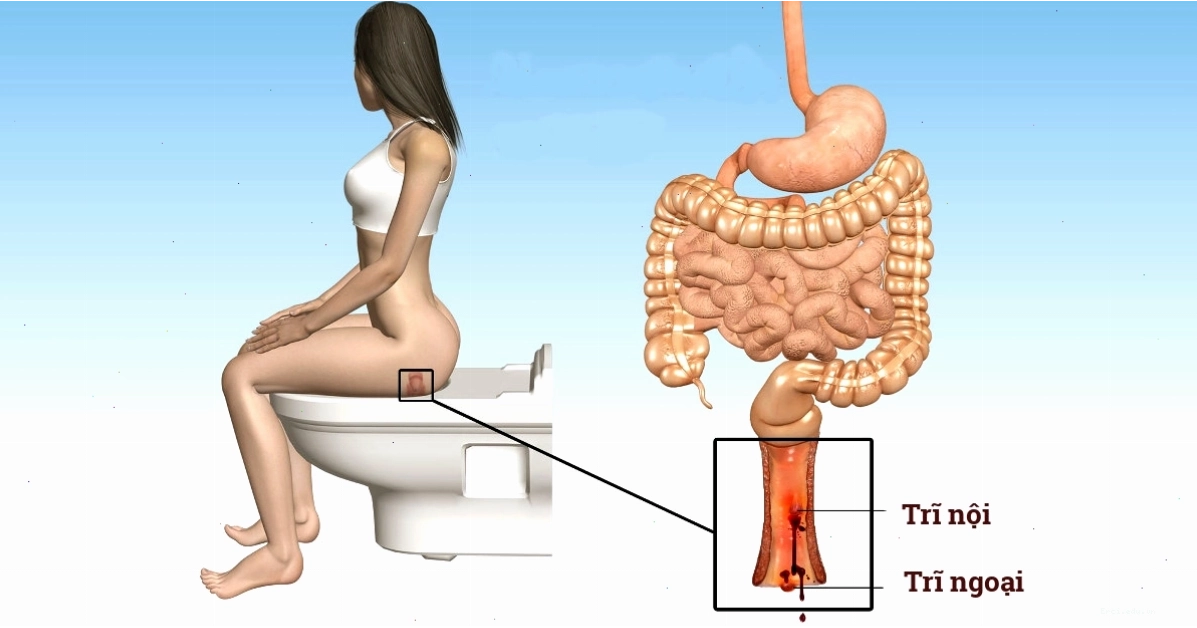 Biểu đồ các triệu chứng của bệnh trĩ nội và trĩ ngoại