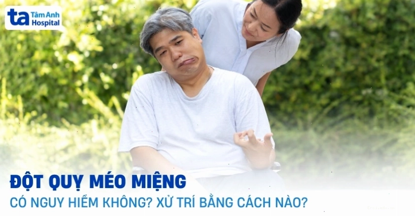 Biểu hiện méo miệng do liệt dây thần kinh số VII