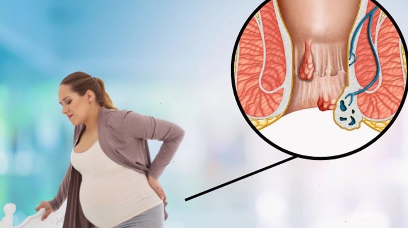 Các loại thực phẩm giàu chất xơ tốt cho người bị trĩ