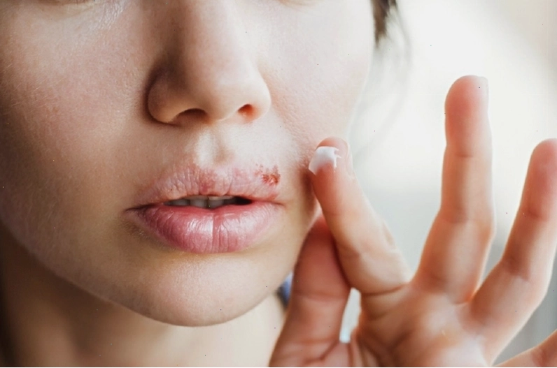 Cách chữa chốc mép bằng kháng sinh tại nhà