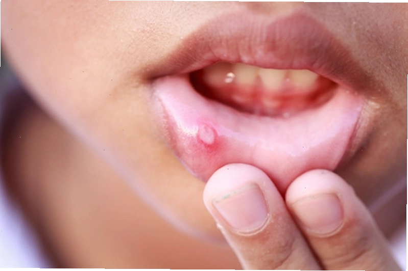 Cách phòng tránh bệnh nhiệt miệng
