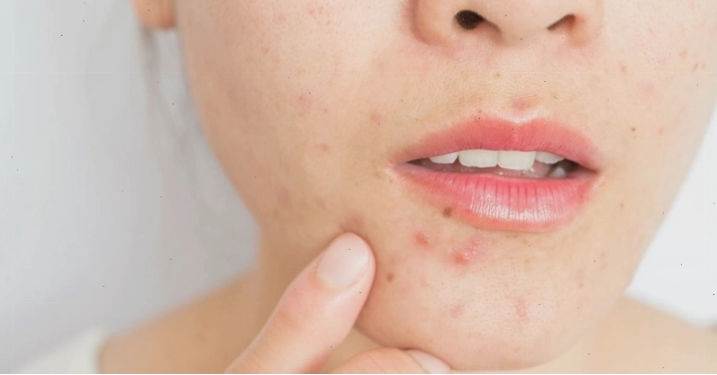 Cận cảnh mụn đinh râu sưng đỏ quanh vùng miệng
