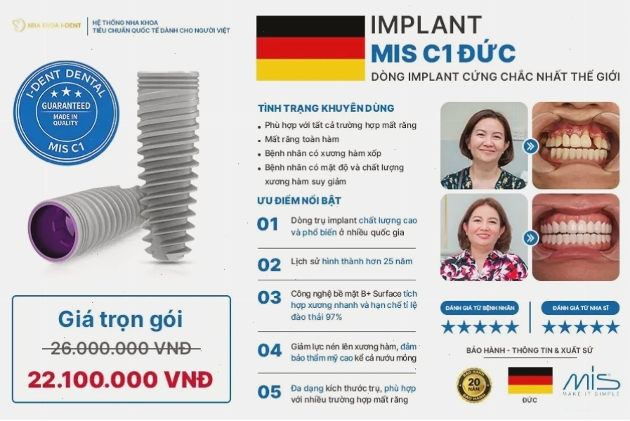 Cận cảnh trụ răng implant sau khi đã tích hợp xương hàm