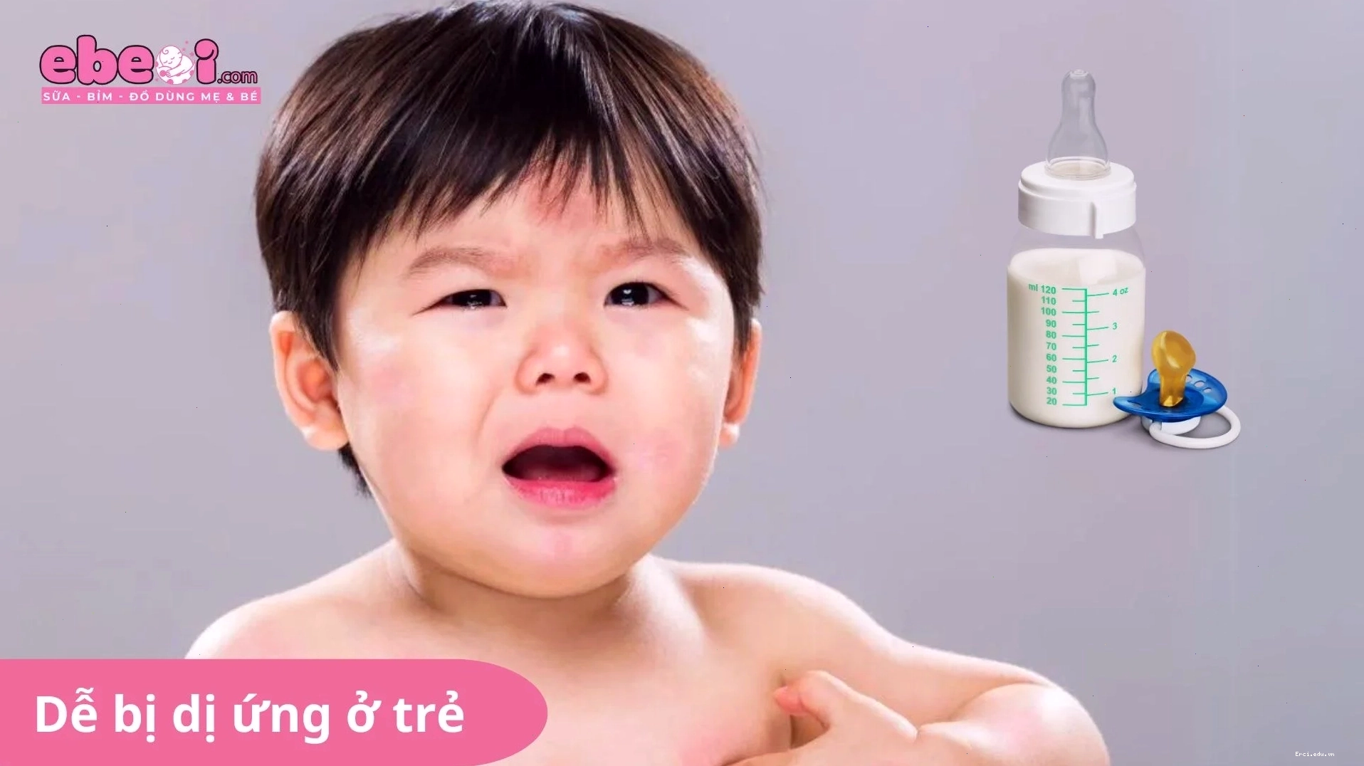 Dấu hiệu dị ứng sữa công thức ở trẻ nhỏ