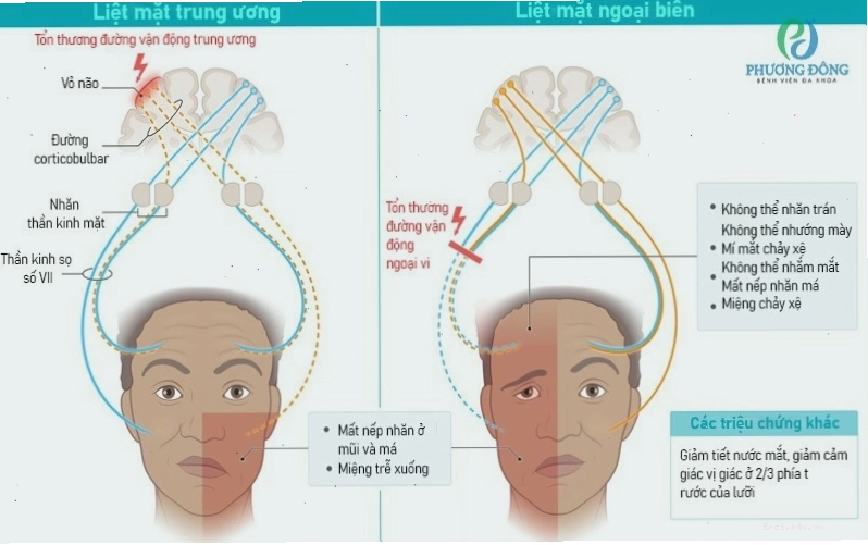 Điểm giống và khác nhau giữa liệt mặt trung ương và liệt mặt ngoại biên