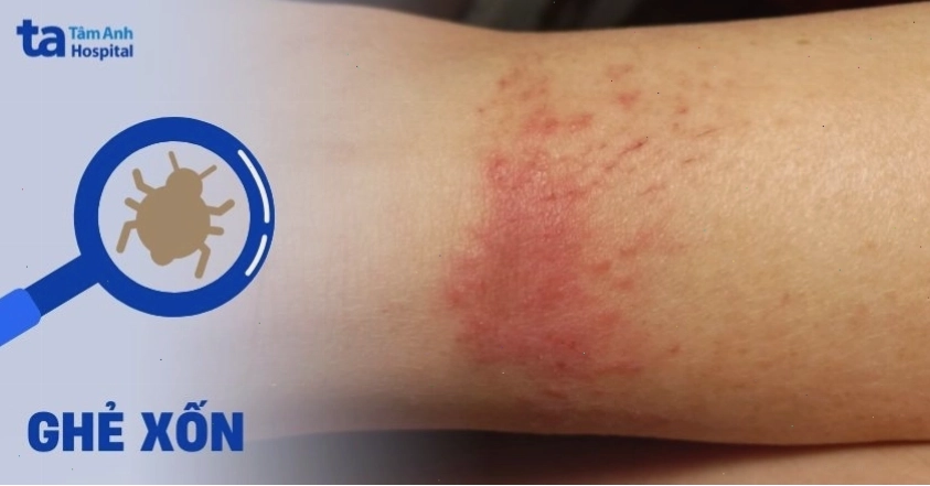 Ghẻ xốn là bệnh da liễu do ký sinh trùng gây ra
