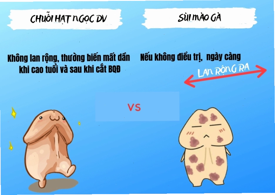 Hình ảnh minh họa cấu trúc sùi mào gà và chuỗi hạt ngọc