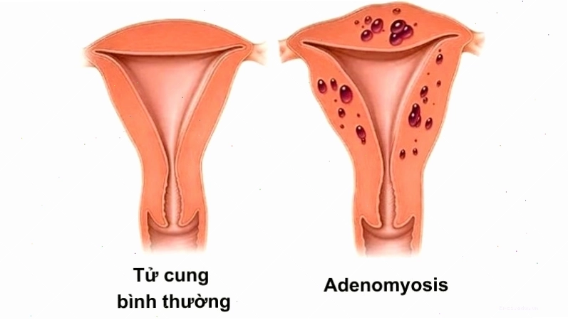 Hình ảnh minh họa lạc nội mạc tử cung, nguyên nhân gây đau bụng kinh dữ dội