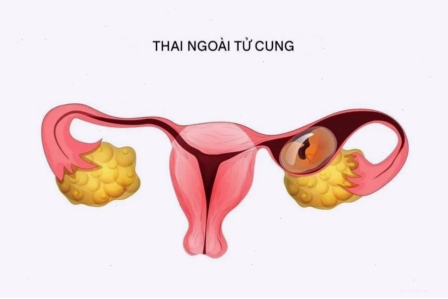 Hình ảnh minh họa thai ngoài tử cung