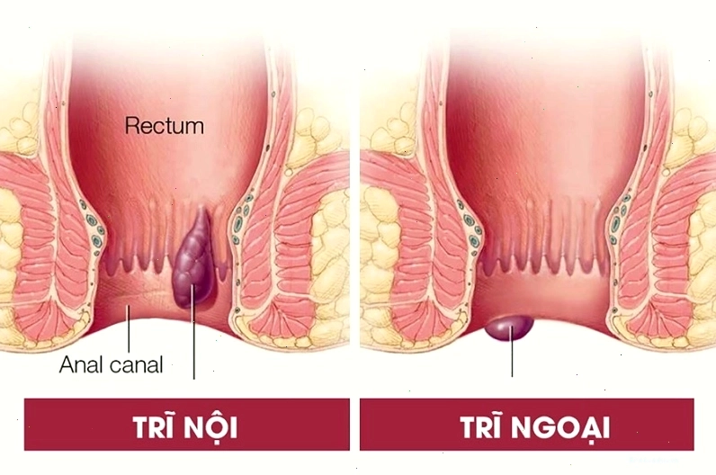 Hình ảnh minh họa vị trí búi trĩ nội bên trong ống hậu môn
