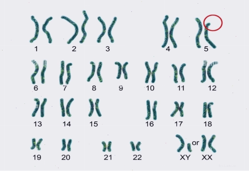 Hội chứng mèo kêu là do bất thường nhiễm sắc thể số 5