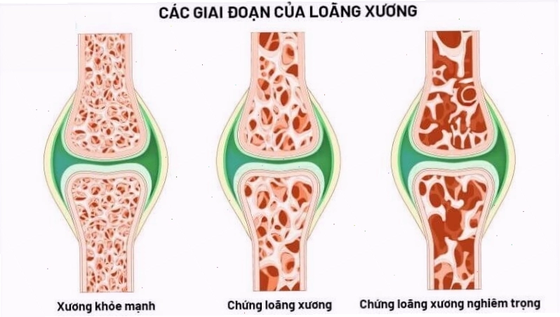 Hồng xiêm cung cấp canxi tốt cho phụ nữ