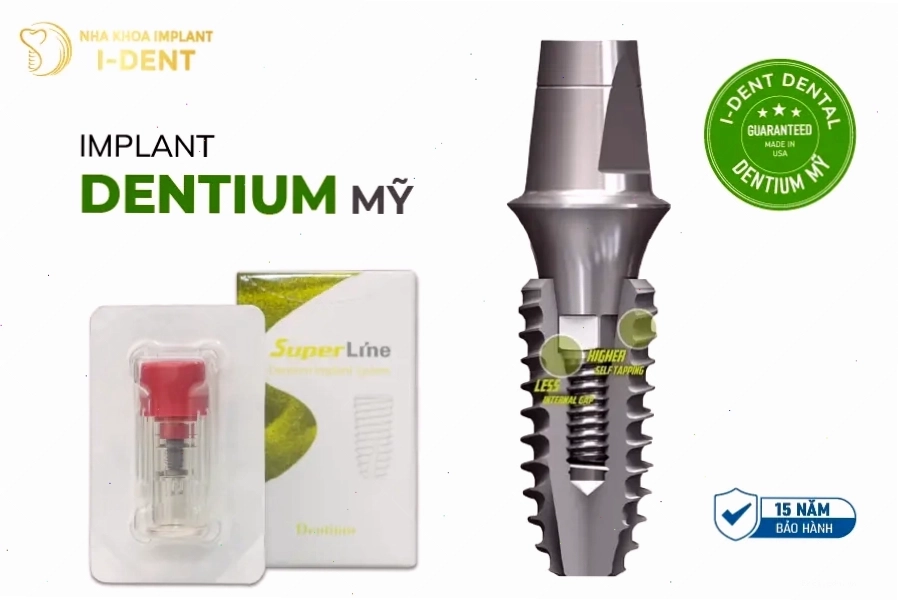 Implant loại nào tốt và phù hợp với từng trường hợp phục hình