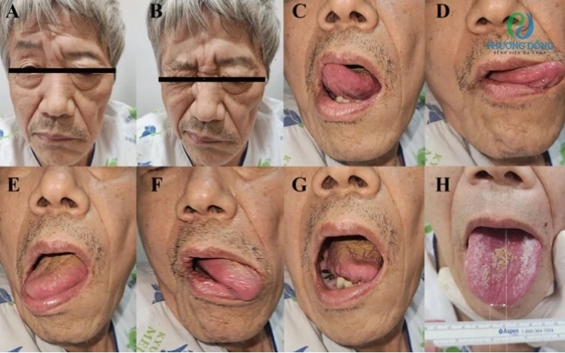 Liệt dây thần kinh mặt ngoại biên bên trái và bằng chứng tổn thương neuron vận động trên