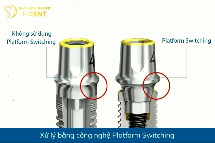 Lựa chọn trụ implant phù hợp dựa trên tư vấn của bác sĩ