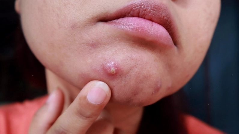 Mụn bọc lớn, sưng đỏ và đau nhức dưới da