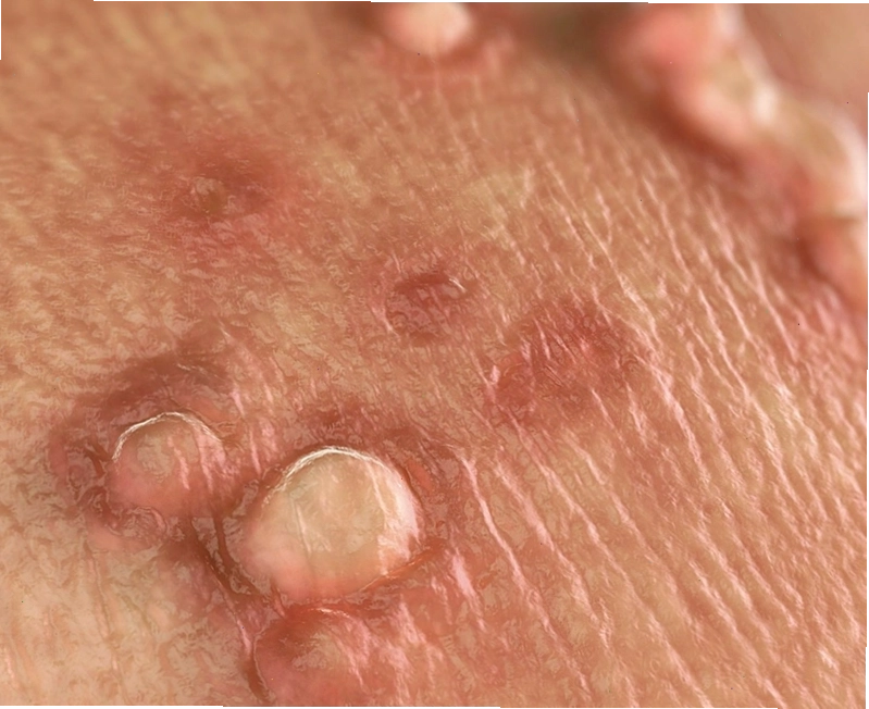 Mụn cóc sinh dục và sùi mào gà là bệnh lý do virus HPV gây ra với các khối u trên da