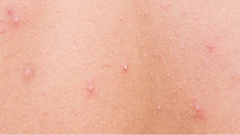 Mụn đầu đen với đầu mụn đen đặc trưng do oxy hóa