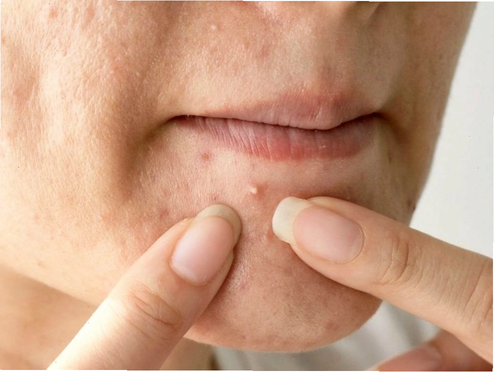 Mụn đầu trắng với đầu mụn nhỏ màu trắng hoặc vàng