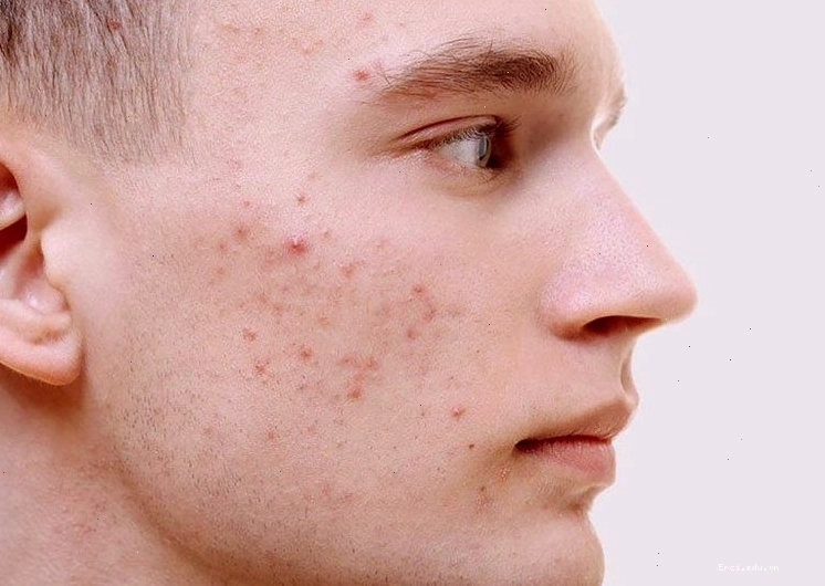 Mụn viêm đỏ gây sưng tấy và đau nhức trên da