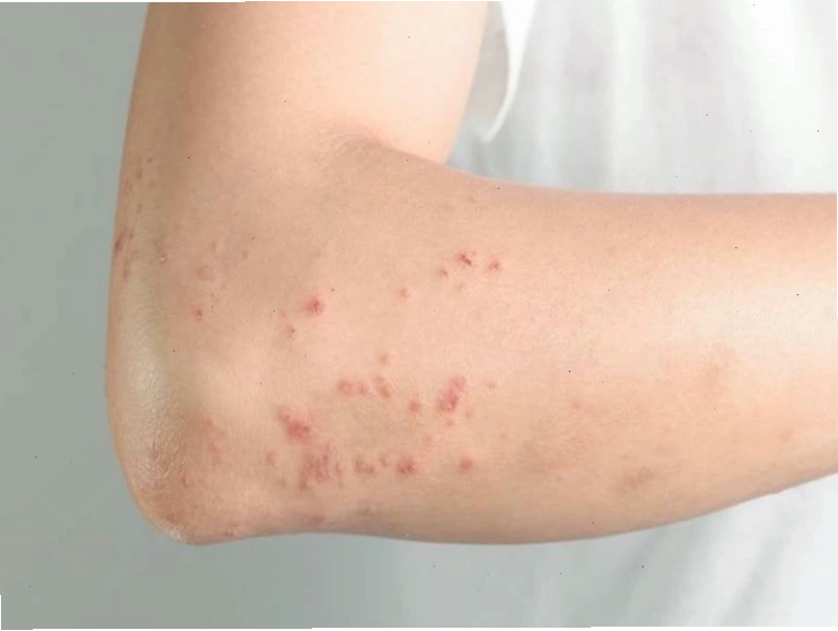 Người bệnh gãi ngứa vùng da bị nổi mẩn đỏ do nhiễm giun đũa chó mèo