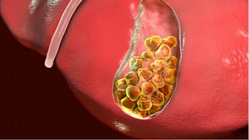 Nguy cơ mắc sỏi cholesterol khi áp dụng chế độ ăn có đậu phộng