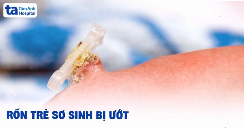 Rốn trẻ sơ sinh bị ướt phải làm sao nhanh khô trước và sau rụng?